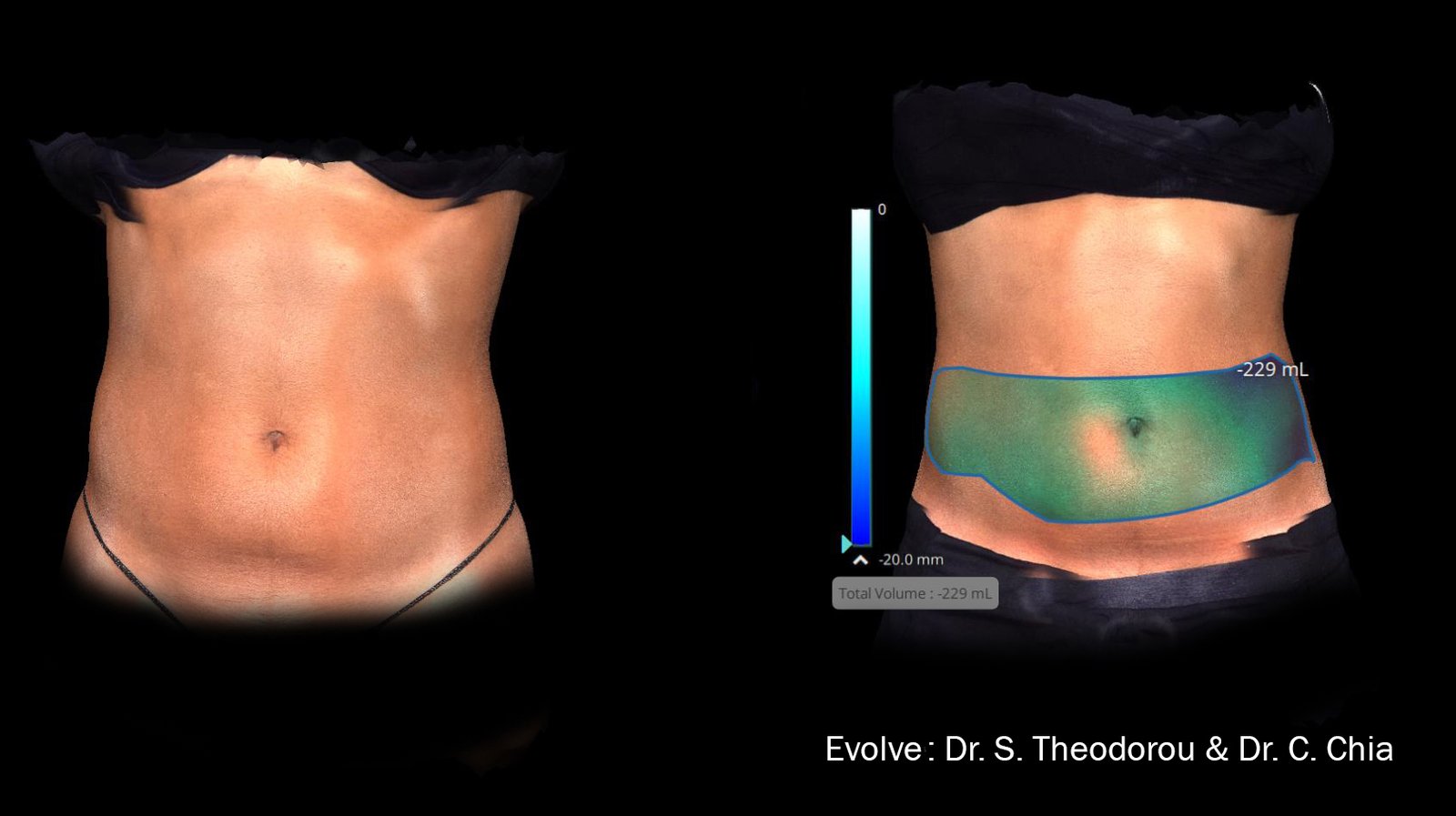 Evolve Trim remodela los tejidos y se dirige al tejido adiposo profundo en áreas Problemáticas.