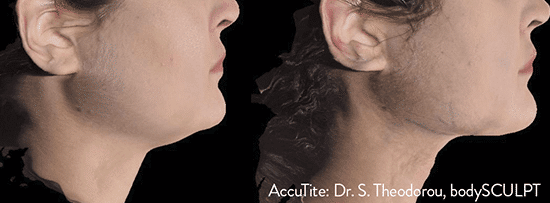 AccuTite-Dr.-S.-Theodorou