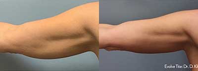 Customizable treatments allow for smaller body areas such as arms to be treated.