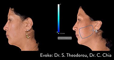 La energía de radiofrecuencia de Evoke remodela mejillas, mandíbula, papada y barbilla.