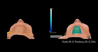 La tecnología de radiofrecuencia de Evoke es altamente segura y efectiva para todo tipo de pieles, para tratamientos no invasivos de remodelación de la piel de la papada y la cara.