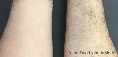 TRITON DUO LIGHT